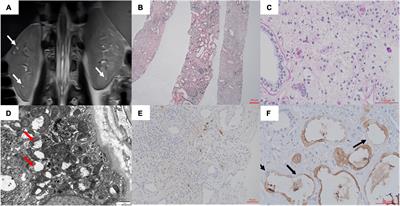 ADTKD-UMOD in a girl with a de novo mutation: A case report